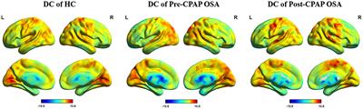 The Effects of CPAP Treatment on Resting-State Network Centrality in Obstructive Sleep Apnea Patients